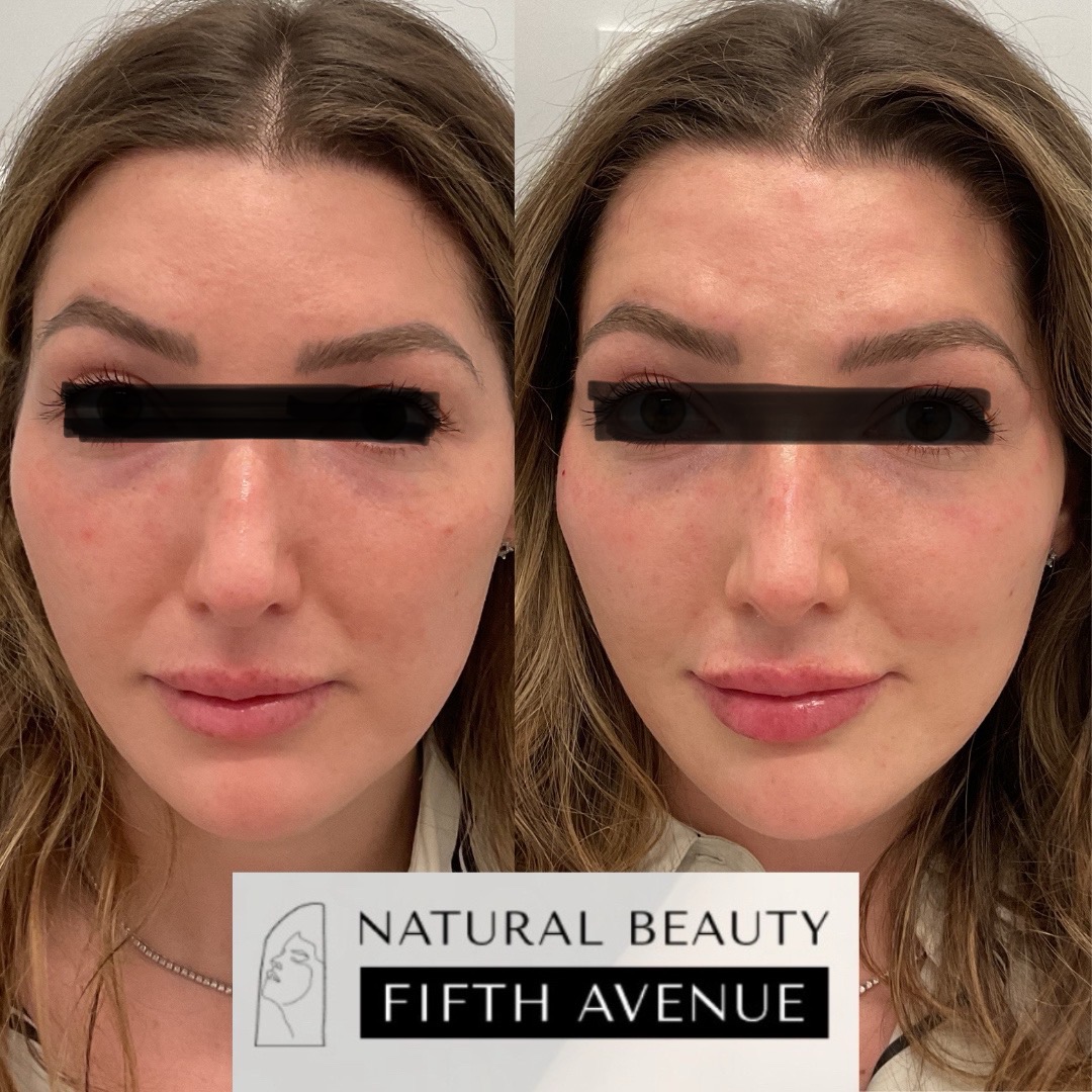 Before and after comparison of a patient's face showing skin texture and complexion improvement from a medspa treatment
